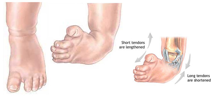 Club Foot Chicago Foot Care Clinic Club Foot Chicago Foot Care Clinic