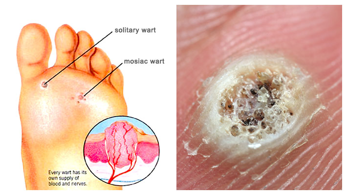 foot wart vs corn papilomavirus puternic cancerigen