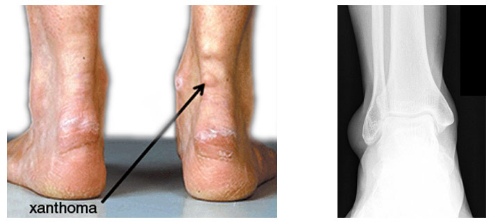 Achilles Tendon Xanthoma Achilles Tendon Xanthoma